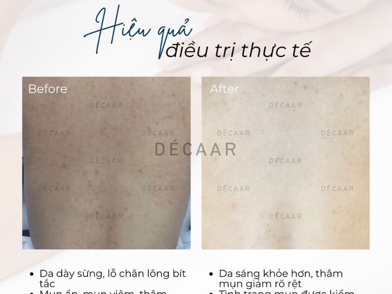 sản phẩm peel da body